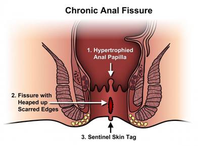 Image result for Fissure