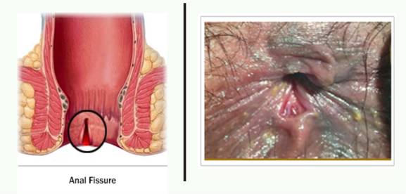 Image result for Fissure